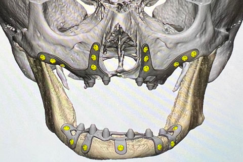 Implantes subperiósticos