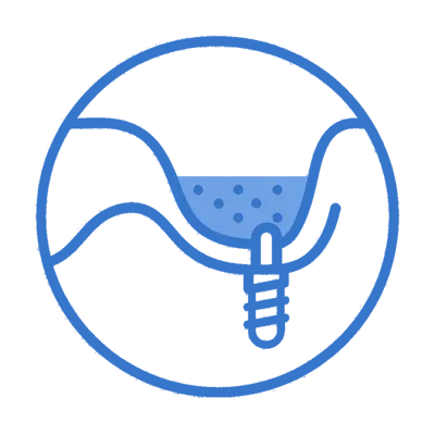 elevación sinusal lateral elevación sinusal lateral