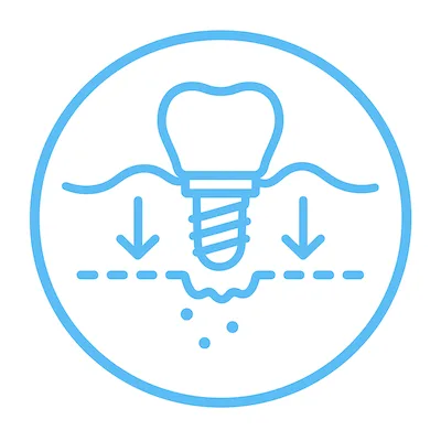 Implantes Subperiósticos Implantes subperiósticos